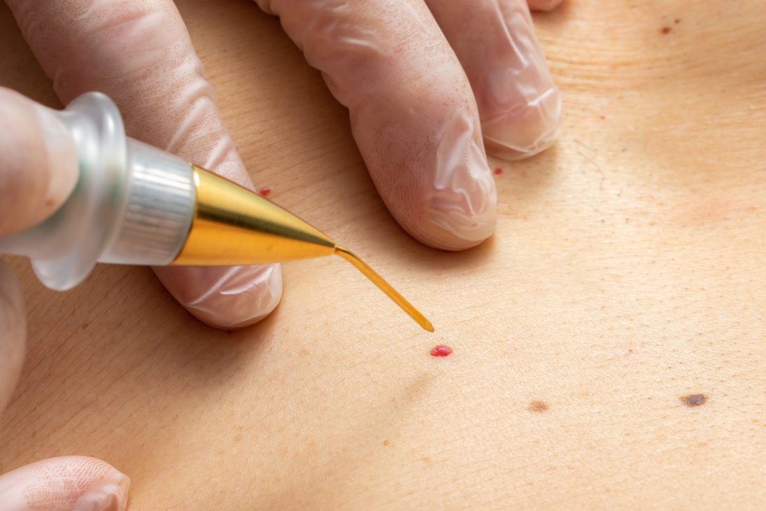 Macro close up of laser plasma pen removing cherry angioma on human skin.
